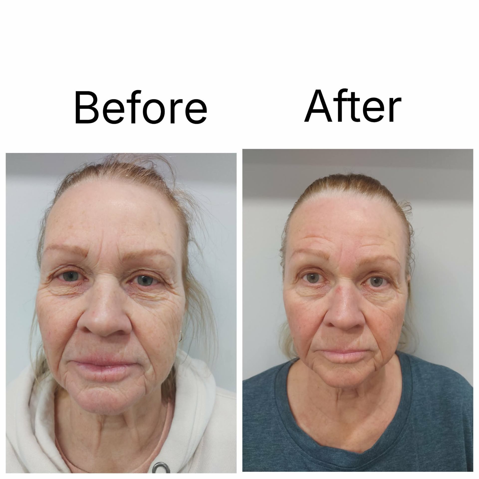 Before and after — Diamond Medi Spa client