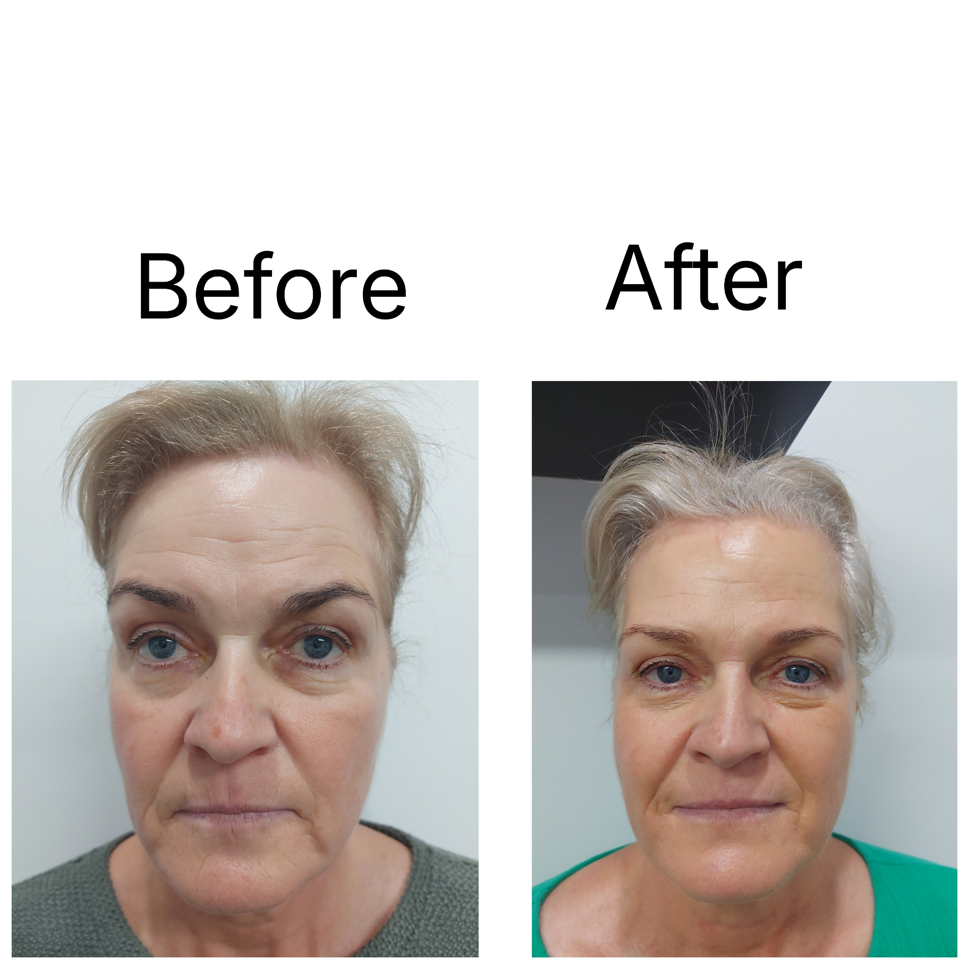 Before and after — Diamond Medi Spa client