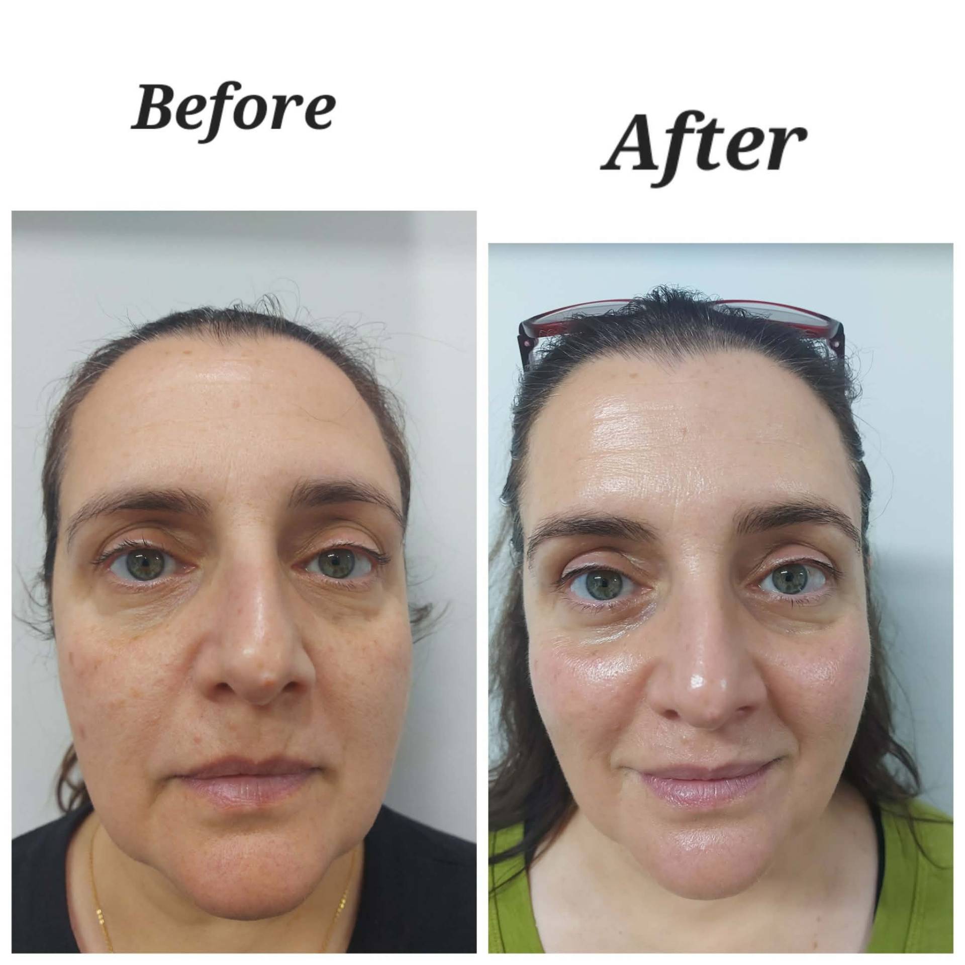 Before and after — Diamond Medi Spa client