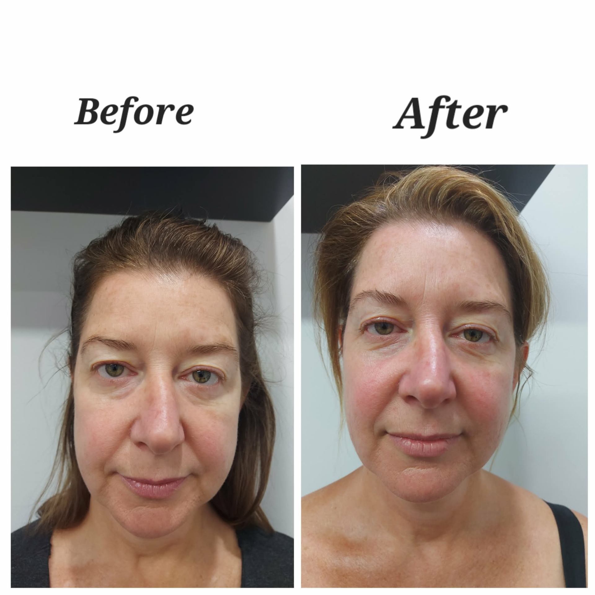 Before and after — Diamond Medi Spa client