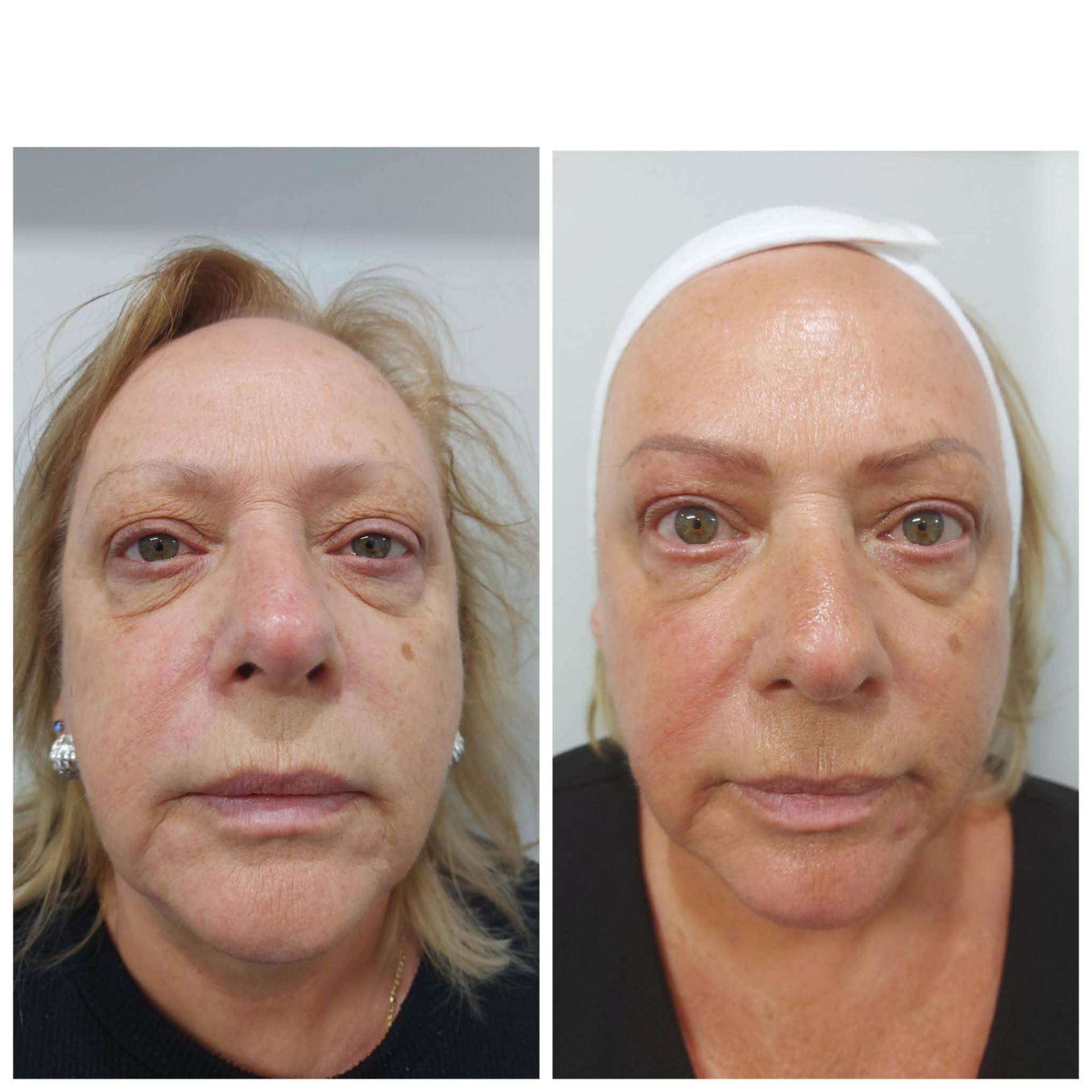 Before and after — Diamond Medi Spa client