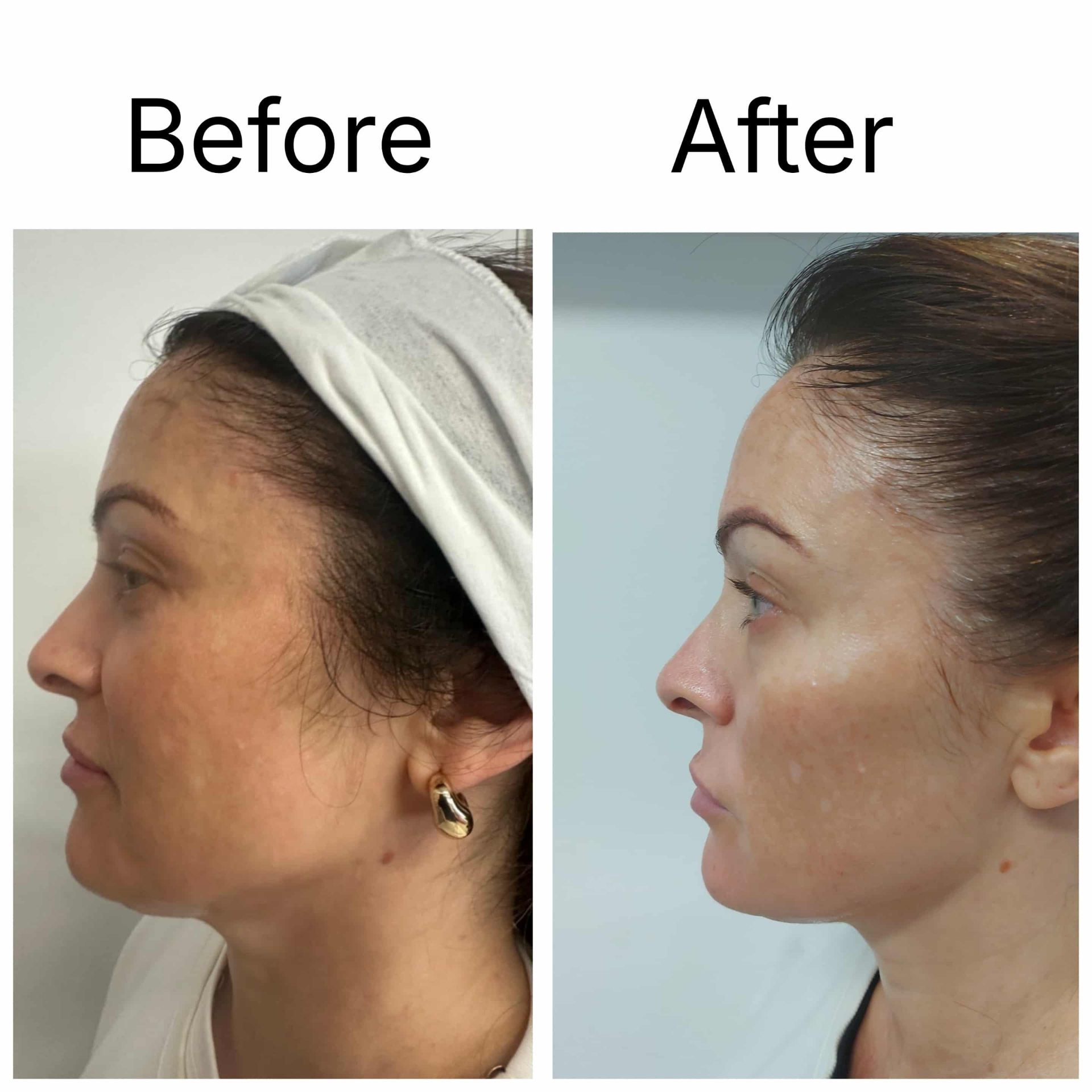 Before and after — Diamond Medi Spa client